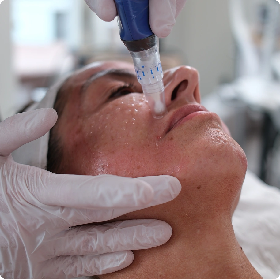SkinPen Microneedling Process Hornchurch