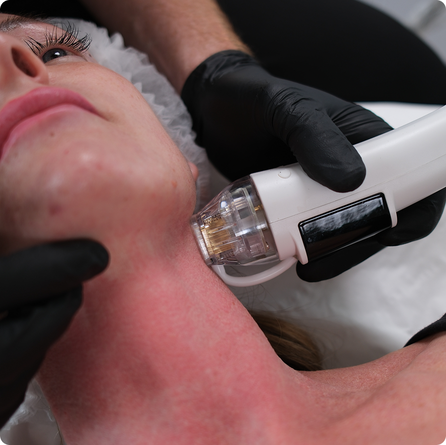 PureDerma-RF-Procedure-Hornchurch PureDerma-RF-Procedure-Hornchurch