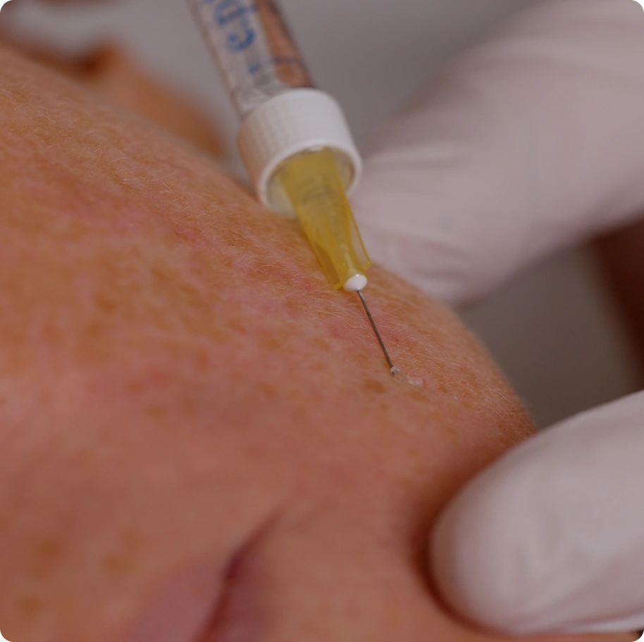 About Polynucleotide Injectables (Vitaran) in Hornchurch About Polynucleotide Injectables (Vitaran) in Hornchurch