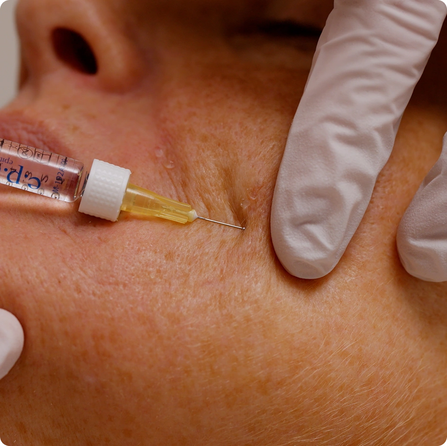 After Care Polynucleotide Injectables (Vitaran) in Hornchurch