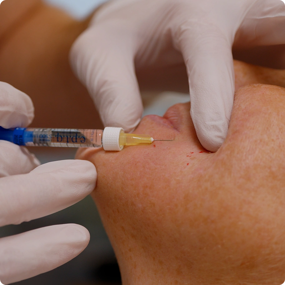 Procedure Polynucleotide Injectables (Vitaran) in Hornchurch Procedure Polynucleotide Injectables (Vitaran) in Hornchurch