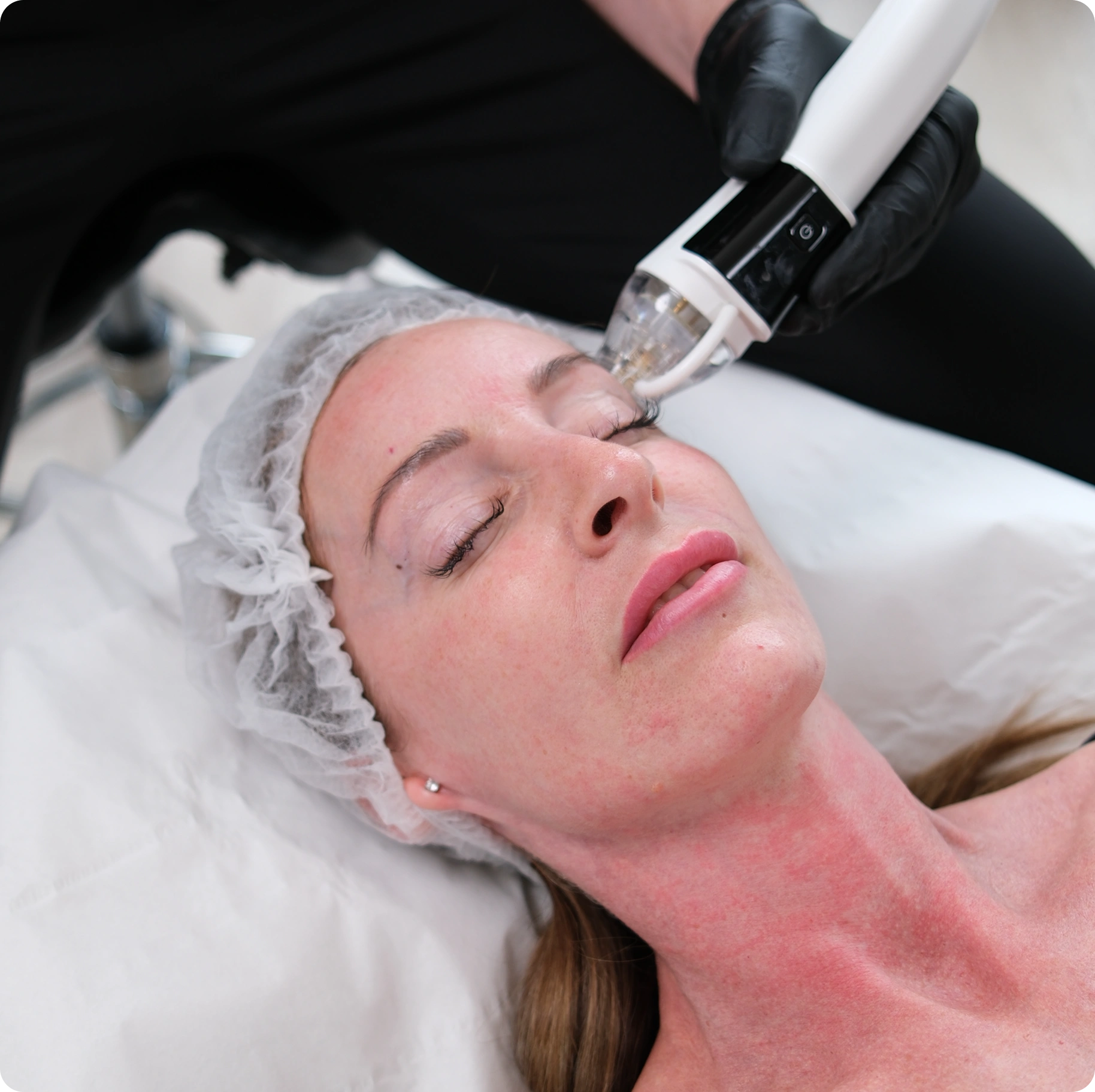 After Care PureDerma treatment After Care PureDerma treatment