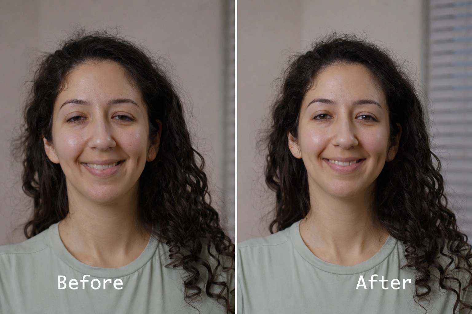 Before and After Derma Fillers Before and After Derma Fillers